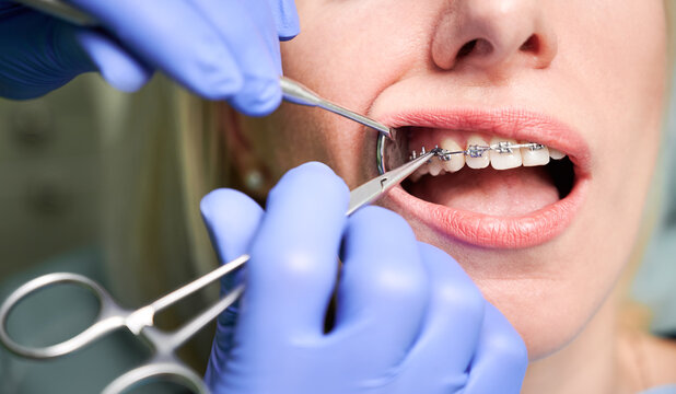 Mutuelles pour l'orthodontie